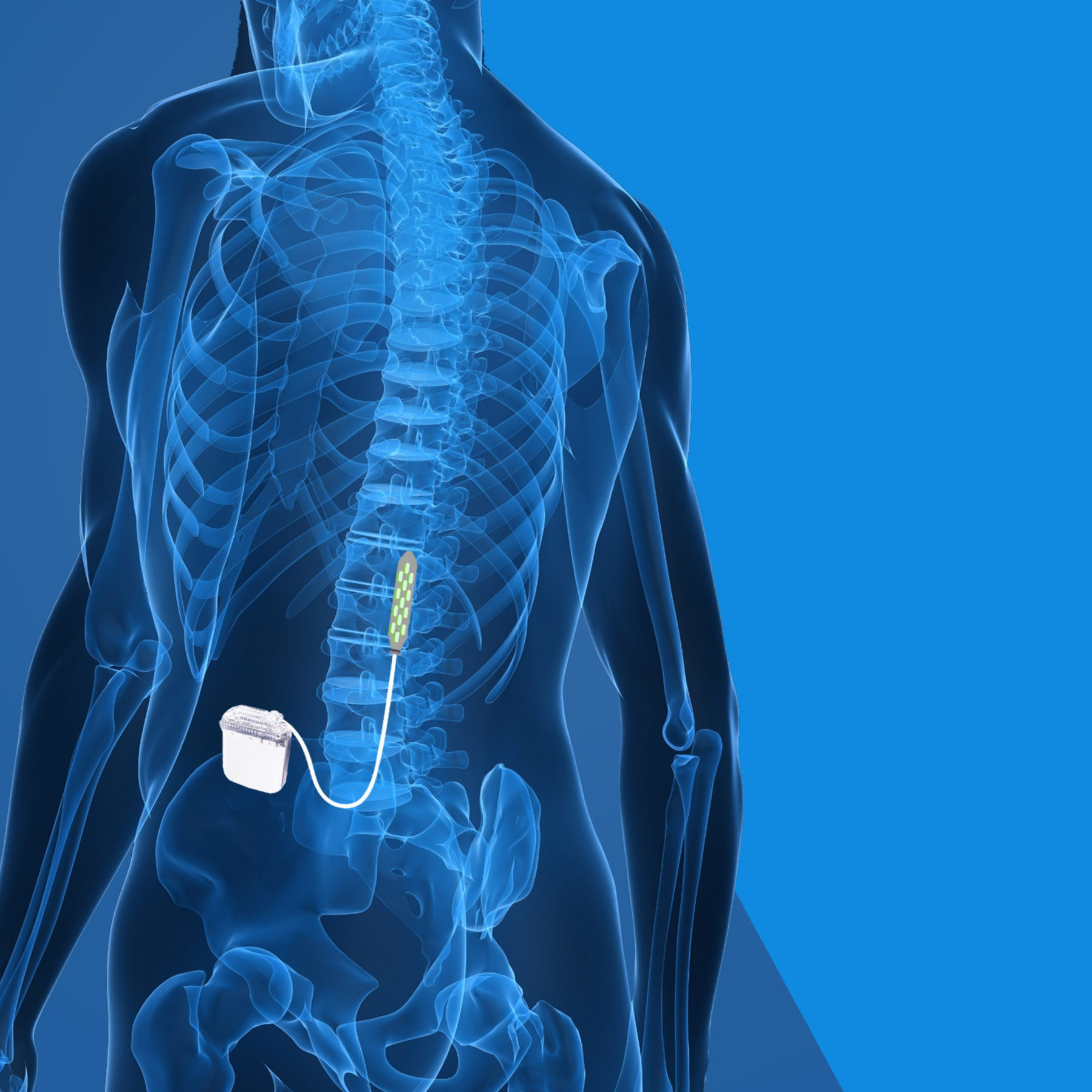 Epidural Spinal Cord Stimulation