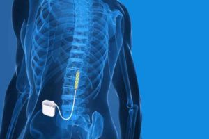 Eligible patients can see a positive future after spinal cord injury with Epidural Stimulation