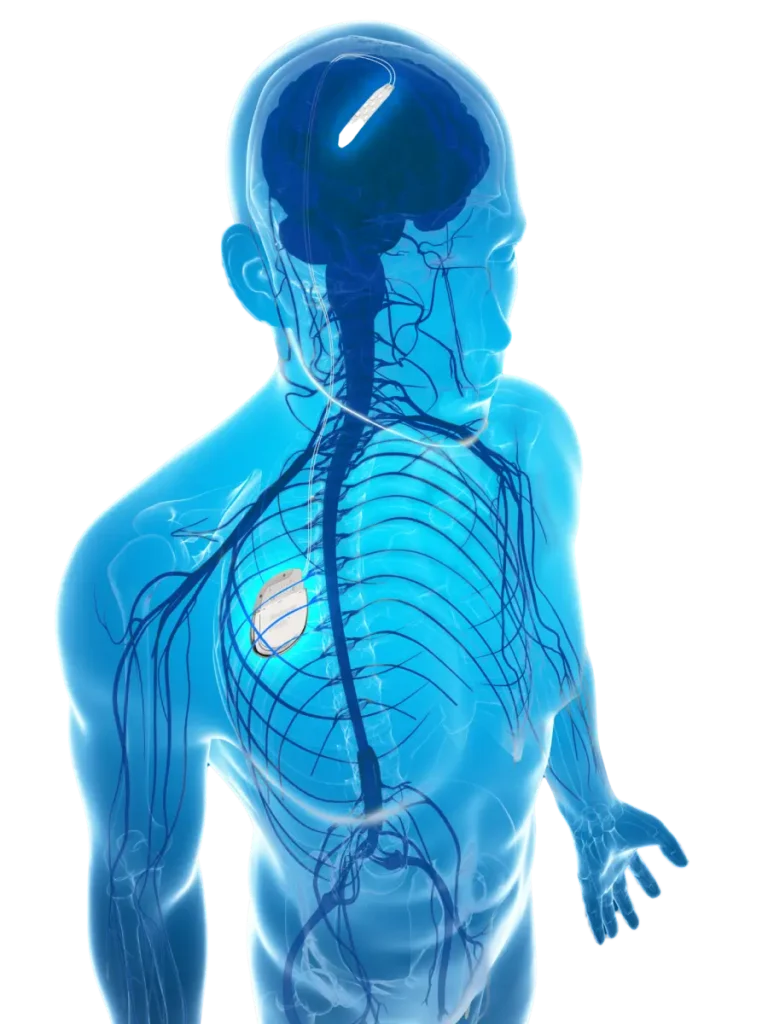 Graphic illustration showing a Verita Neuro brain stimulator device implanted in a human head, highlighting the neural implant's position and its connection points within the brain for neurological treatment.