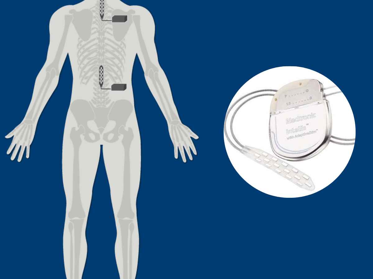 Verita Neuro - Blog - Header Image - Utilizing a Double Epidural Electrical Stimulation Implant For SCI